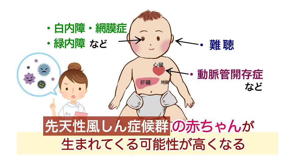 先天性風しん症候群 （CRS）